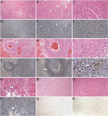 Androgen Receptor, Although Not a Specific Marker For, Is a Novel Target to Suppress Glioma Stem Cells as a Therapeutic Strategy for Glioblastoma